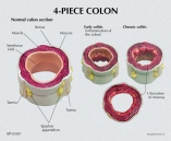 4-Piece Colon With Pathologies Pharmaceutical and Anatomical Model Gifts